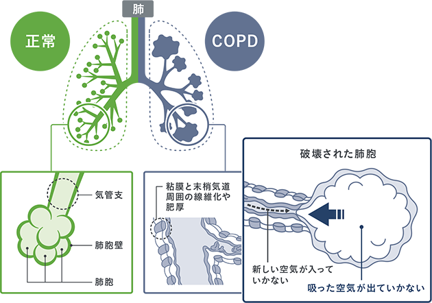 慢性 肺気腫