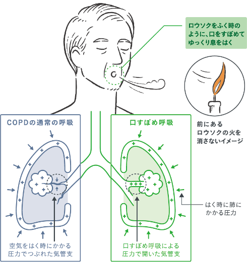 口すぼめ呼吸 Copd 慢性閉塞性肺疾患 に関する情報サイト